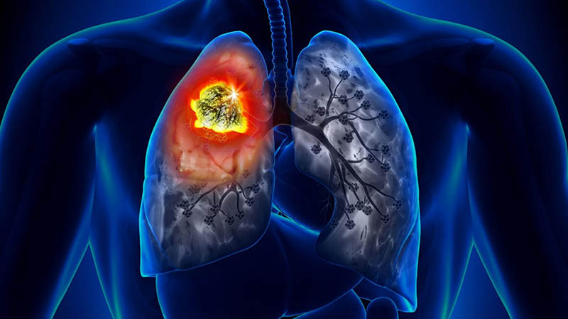 Genentech’s Double Checkpoint Inhibitor Combo Shows Promise in Lung Cancer