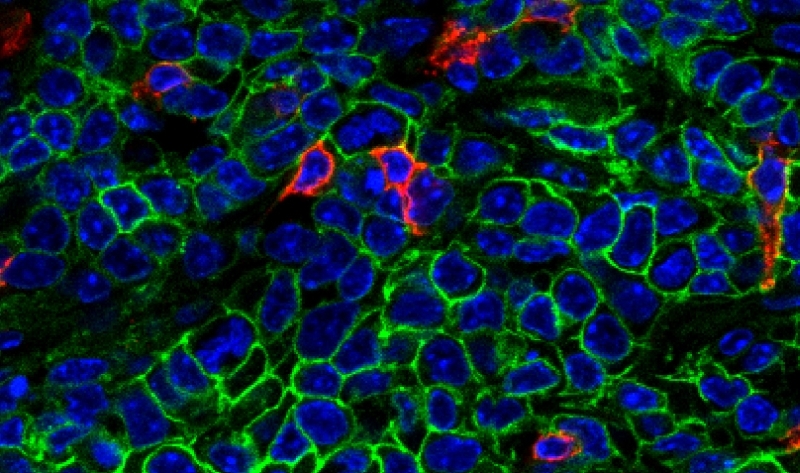 How breast cancer cells evade immune defenses