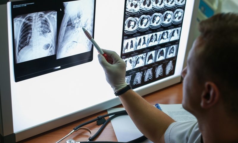 Genentech taps Imbio to develop AI programs for scanning lung diseases