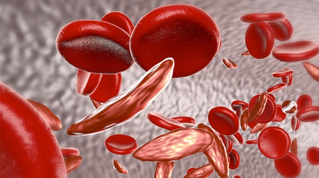 FDA Places New CMC Demands on bluebird’s Sickle Cell Treatment