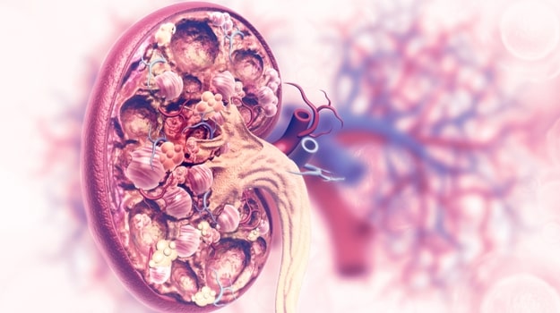 Anteris Invests in Nrf2 Activator to Combat Renal Disease