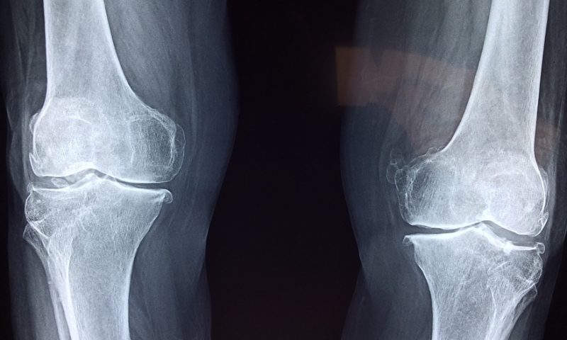 Stryker acquires digital knee replacement developer OrthoSensor