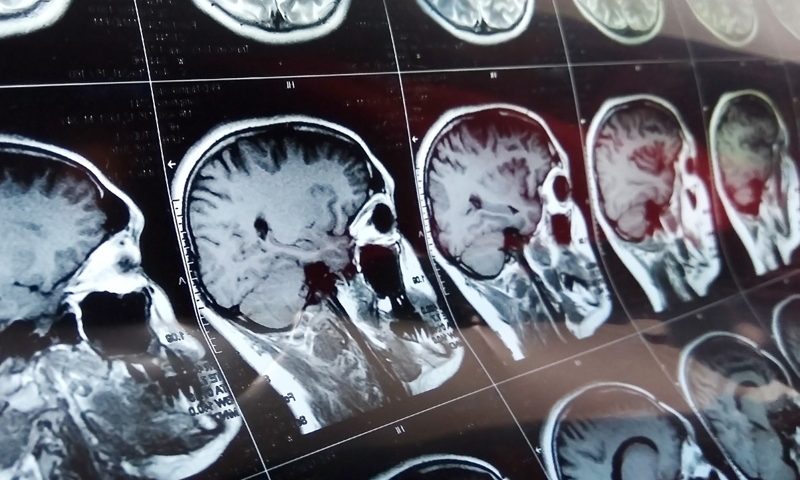 Canon Medical expands reach of its MRI artificial intelligence programs