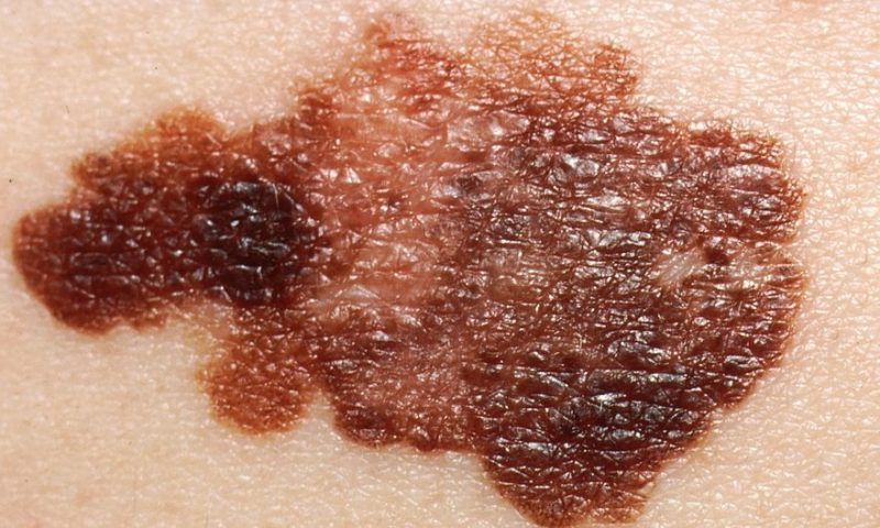 Idera’s TLR9 drug flunks melanoma phase 3, tanking stock