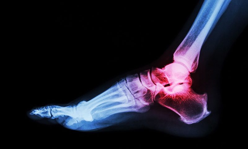 FDA issues safety alert for plastic breaks in Stryker-made STAR ankle replacements