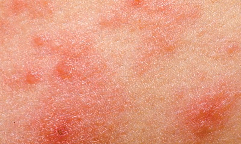 Pfizer’s abrocitinib beats blockbuster Dupixent in phase 3 eczema trial, but key questions remain