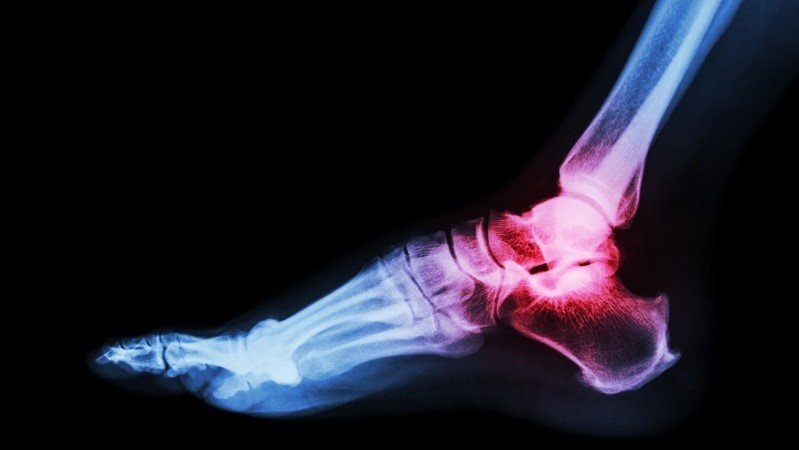 At the CrossRoads: J&J’s DePuy Synthes acquires foot and ankle implant system maker
