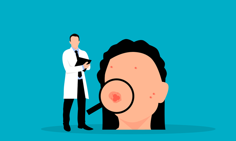 Researchers find 29 genetic variants in people with acne that could lead to new treatments