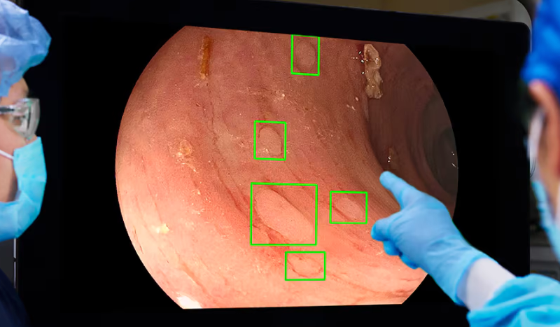Medtronic’s colonoscopy AI cuts number of missed polyps in half, study finds