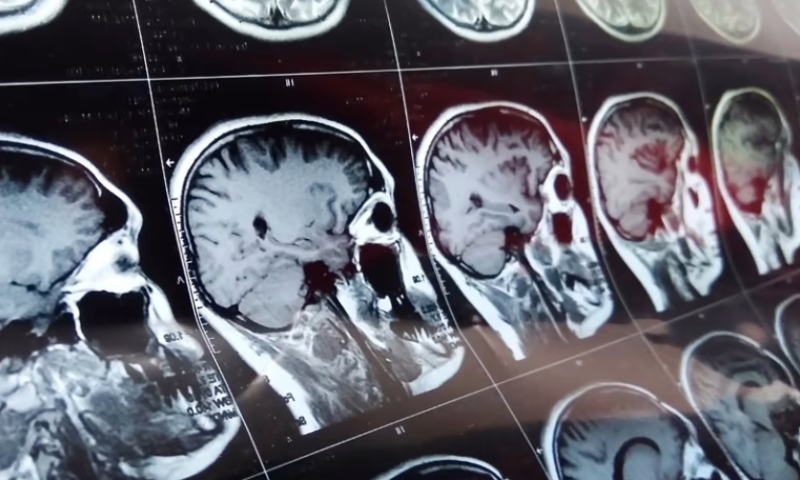 Aidoc locks down FDA OK for brain aneurysm-spotting AI, its 9th agency nod