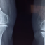 FDA approves Orthofix’s ultrasonic bone fracture healing system