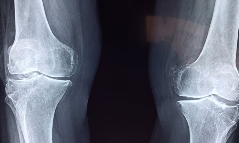 FDA approves Orthofix’s ultrasonic bone fracture healing system