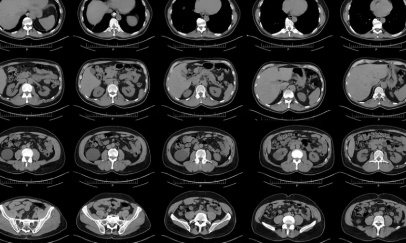 Cedars-Sinai AI catches pancreatic cancer in CT scans years in advance: study