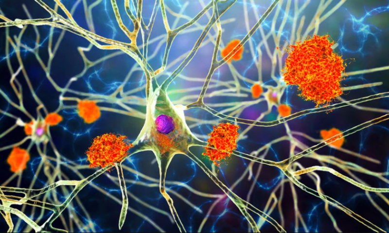 Plaque to basics: New research hints Alzheimer’s treatments may be looking in the wrong place