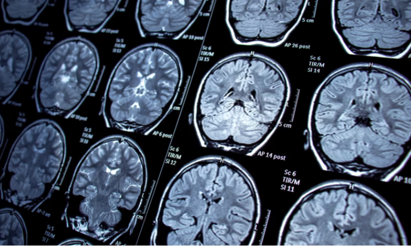 FDA clears Viz.ai’s algorithm to spot internal bleeds in brain scans