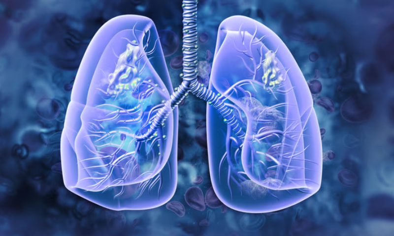 Intuitive joins $14M funding for lung cancer AI developer Optellum