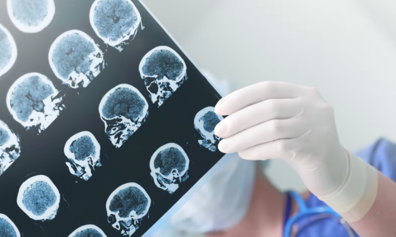Mount Sinai AI uncovers new brain analysis method to predict dementia, Alzheimer’s disease