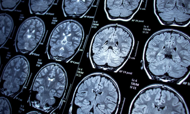 FDA canonizes Magnus Medical’s Saint neuromodulation system to treat severe depression