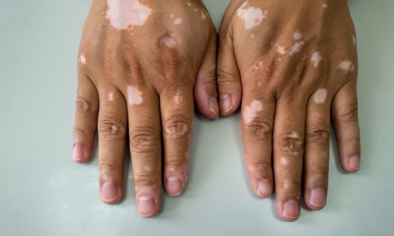 Incyte scoops up preclinical biotech to widen footprint in vitiligo