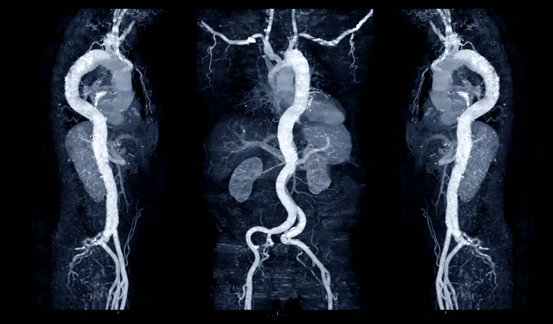 Viz.ai’s deep learning AI spots suspected aortic dissections with high accuracy: study