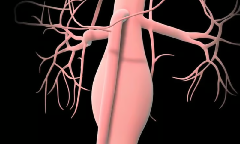 Viz.ai snags FDA nod for AI to spot abdominal aortic aneurysms in chest scans