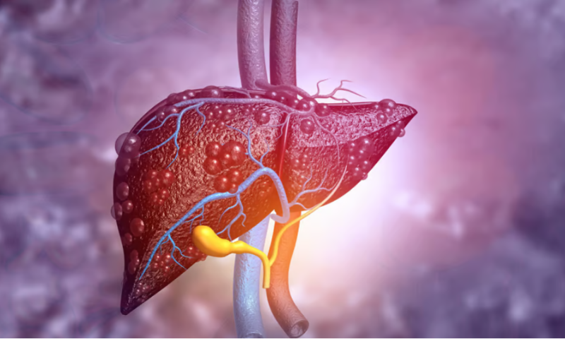 Hepion shares midphase NASH data that leave questions unanswered ahead of key clinical readout