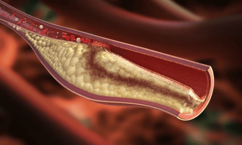 Scientists pinpoint location of plaque ruptures, and a protein that predicts them