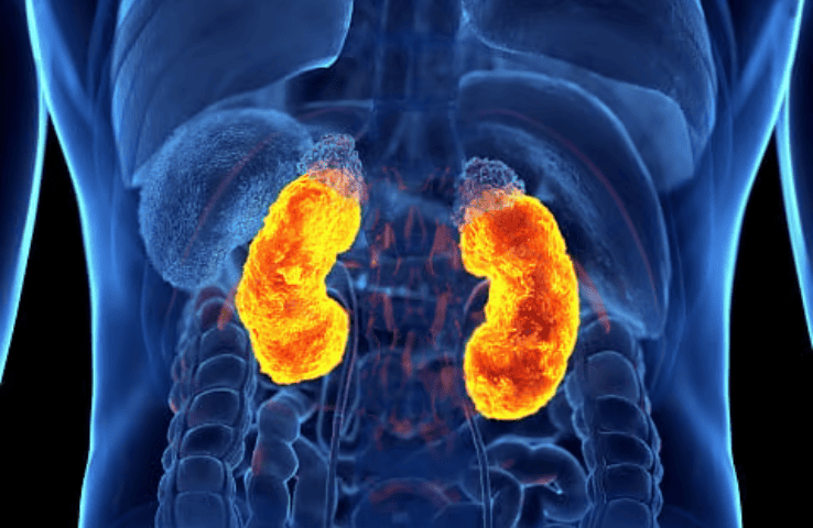 Renalytix scores long-awaited FDA de novo nod for AI-powered kidney disease test