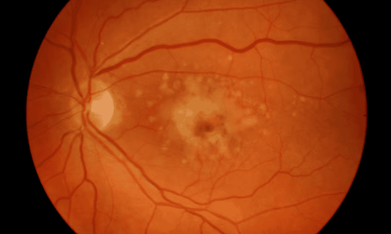 RetinAI Medical joins non-profit macular degeneration initiative