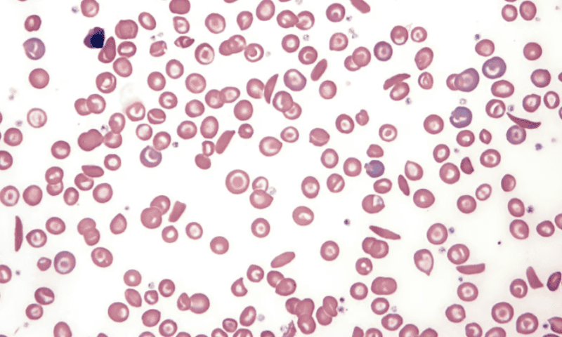 Sickle cell gene therapy process may cause cancer-linked mutations in blood stem cells