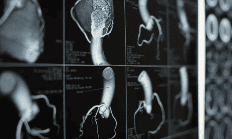 Chasing Merck, AstraZeneca’s PCSK9 inhibitor lowers cholesterol in phase 1 test