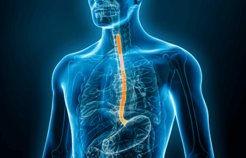 As esophageal cancer incidence rises, trials and potential treatments burgeon: Novotech report