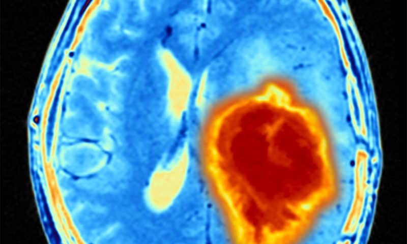 Anti-inflammatory Drug Weakens Immune System’s Response to Brain Cancer