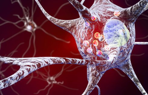 Cholesterol Metabolite Implicated in Parkinson’s Disease Pathology