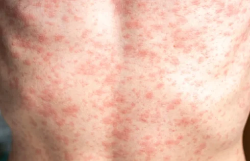 Measles cases are popping up across the country, especially in areas with lower vaccination rates.