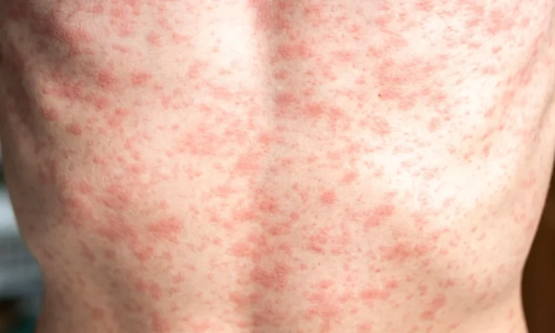 Measles cases are popping up across the country, especially in areas with lower vaccination rates.