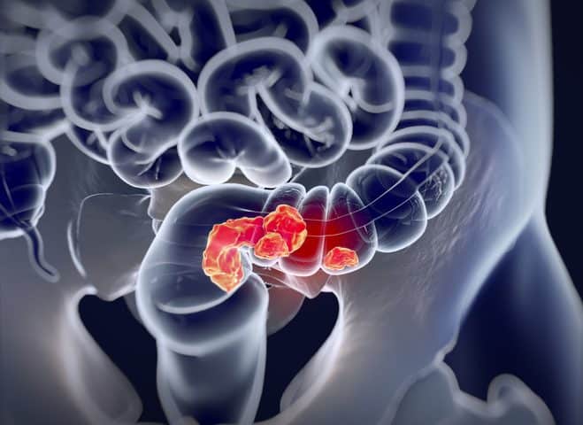 The Oncomicrobe in the Room: Surprise Antimicrobial Agent Targets F. nucleatum