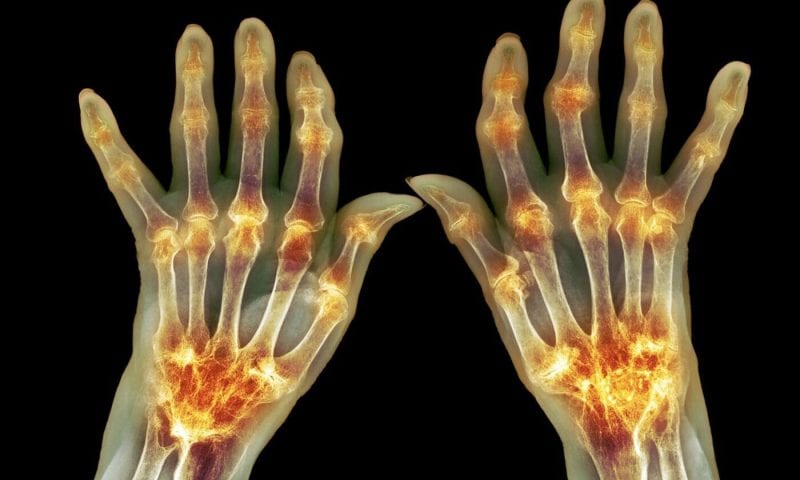 Gut Microbiome Linked to Rheumatoid Arthritis Through Reprogrammed T Helper Cells
