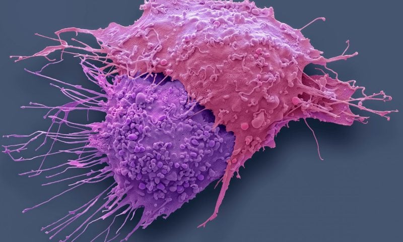 Immune Response in Advanced Ovarian Cancer Weakened by Phospholipids in Ascites
