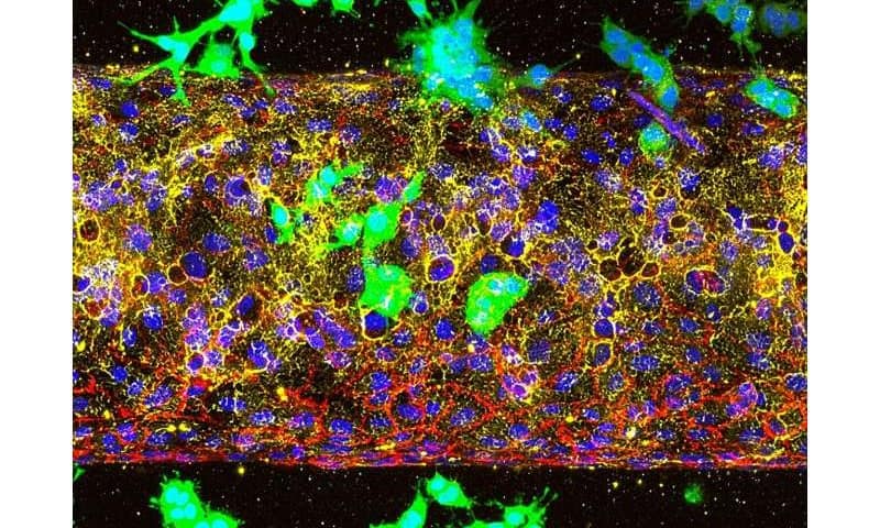 Key driver of pancreatic cancer spread identified