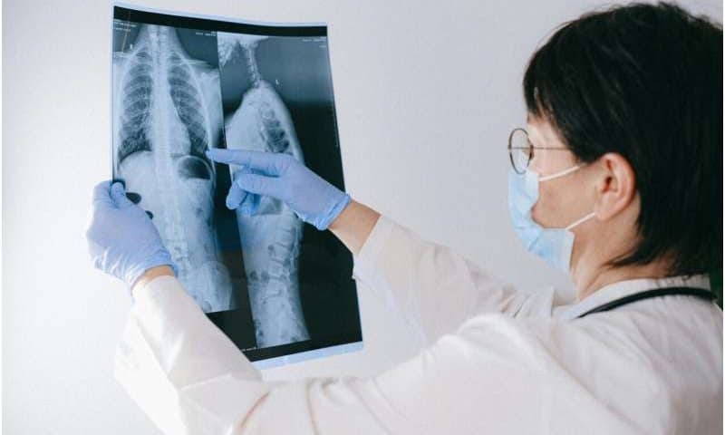 Targeted steroid use may offer a universal complementary treatment to fight TB