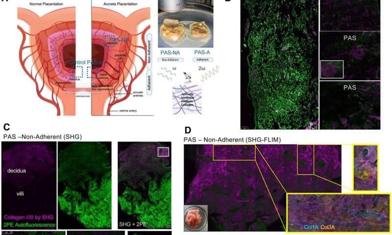 Tangled scar tissue may set stage for dangerous placenta condition