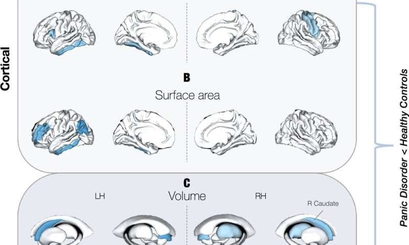 Structural differences found in brains of people with panic disorder