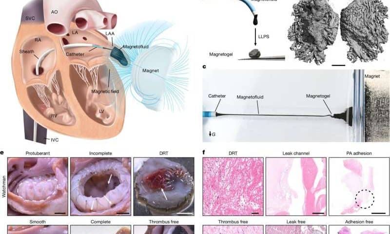 A safer, more effective atrial fibrillation treatment method using magnetic gel may be on the way