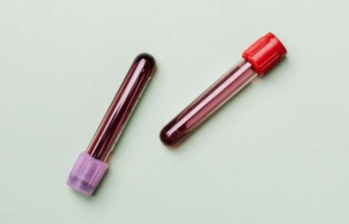 Blood test predicts kidney failure risk to Black Americans years before onset