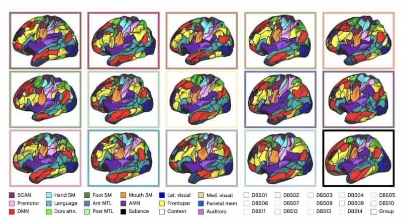 Imaging study sheds light on how deep brain stimulation acts on Parkinson’s disease