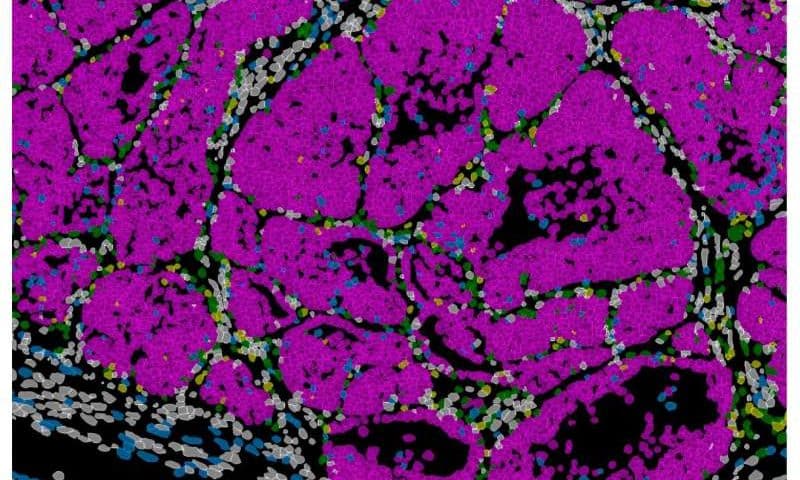 Within primary breast tumors, a high-risk cell state may seed future metastases