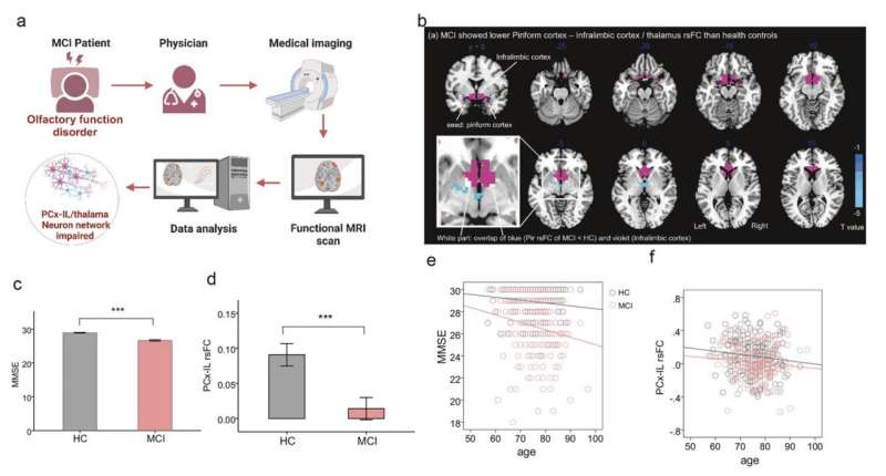 New biological marker of early-stage Alzheimer’s disease uncovered