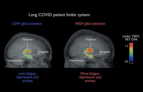 Brain inflammation is unlikely to explain persistent long COVID symptoms, neuroimaging study finds
