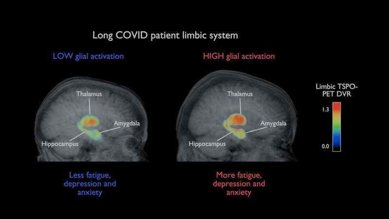 Brain inflammation is unlikely to explain persistent long COVID symptoms, neuroimaging study finds